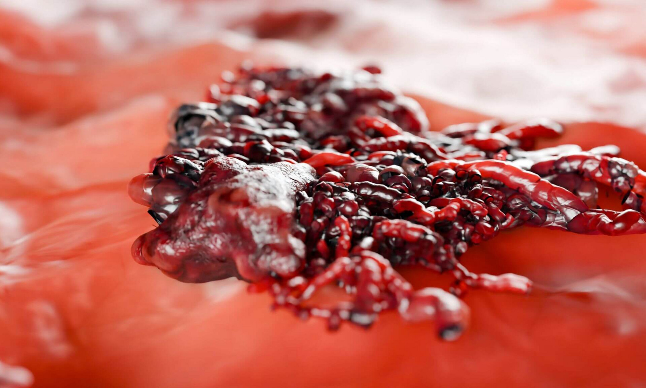 The number of melanoma cases continues to rise in Canada.